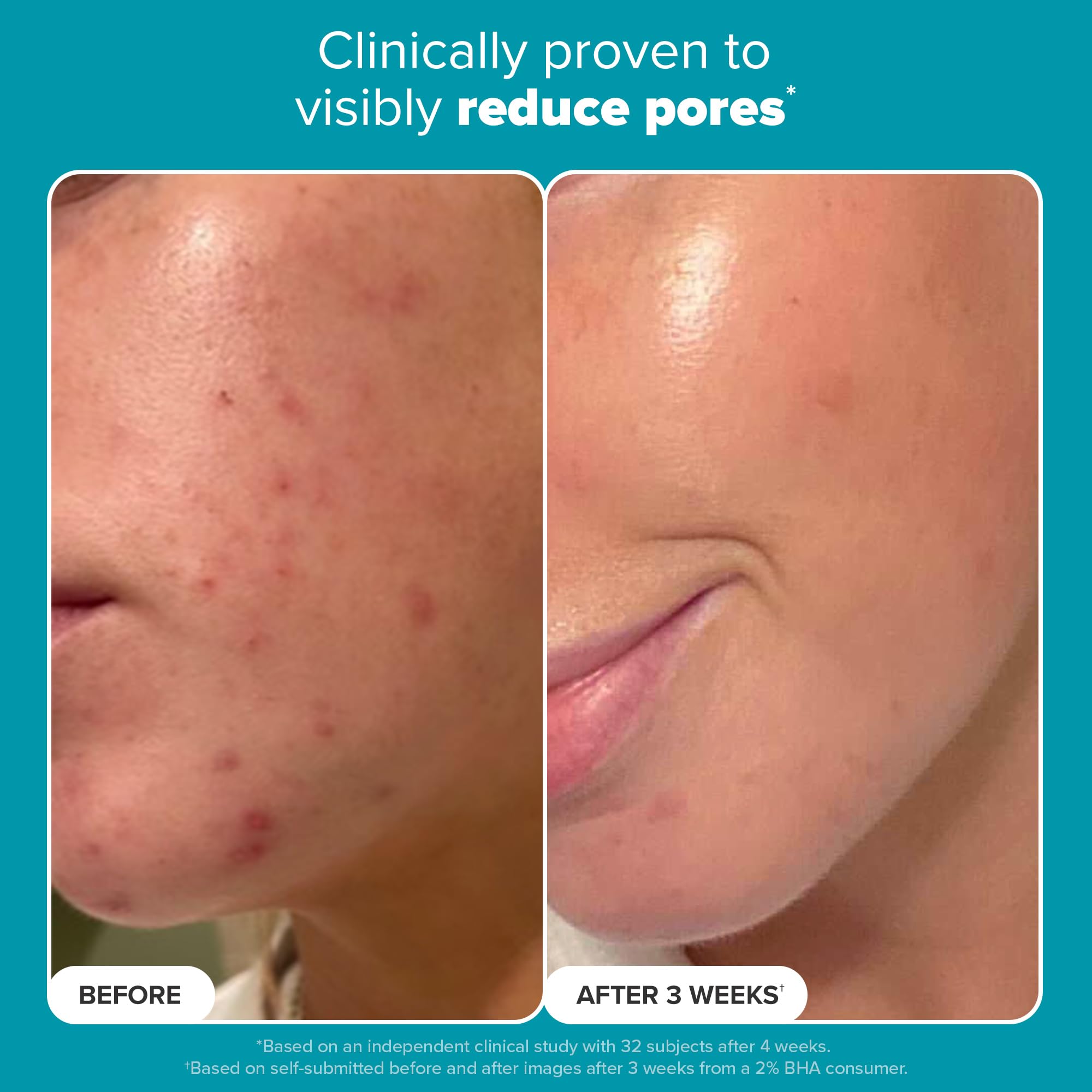 Paula's Choice SKIN PERFECTING 2% BHA Liquid Salicylic Acid Exfoliant, Daily Facial Exfoliator for Enlarged Pores, Wrinkles & Fine Lines, Fragrance-Free, Full Size - 118 ml